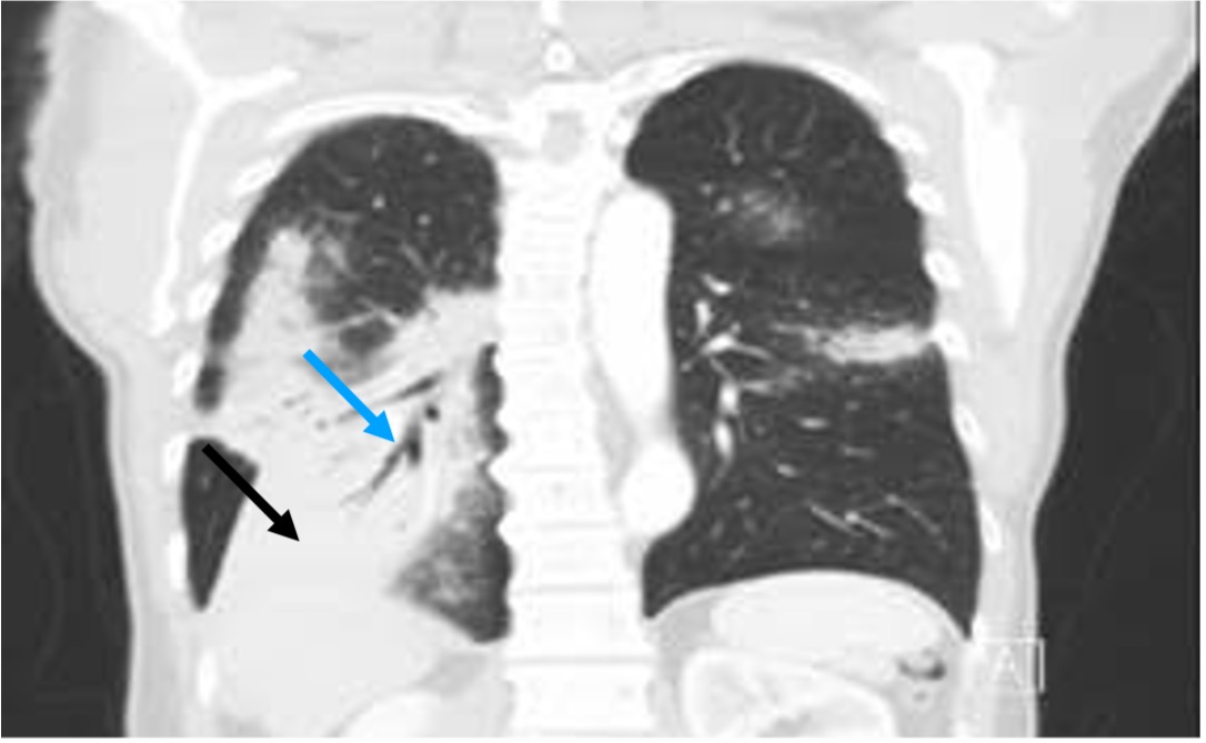 Bcell Lymphoma Detected by a Pulse Oximeter Consultant360